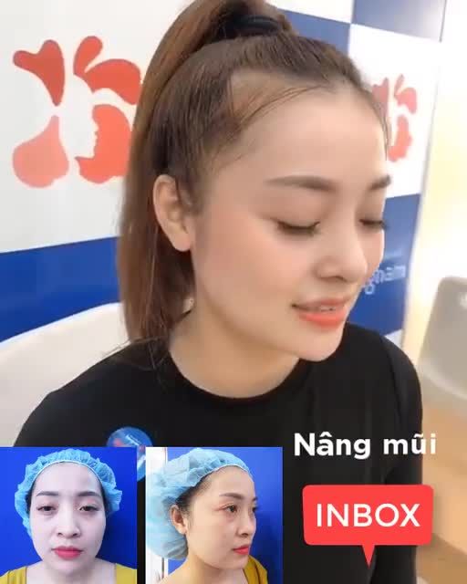 Cận cảnh MŨI ĐẸP NHƯ Ý sau 10 ngày