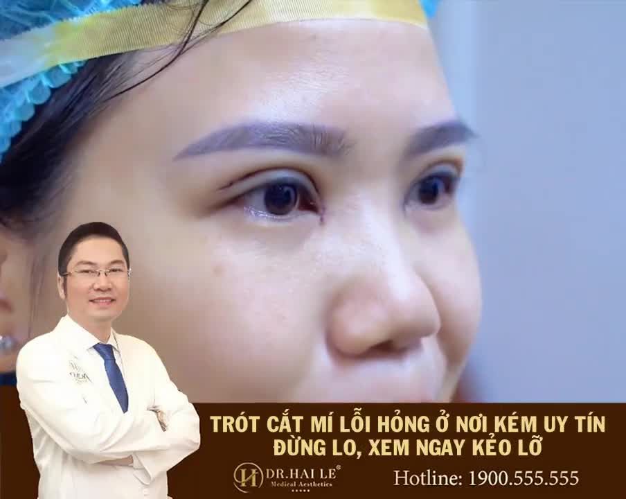 "GIẢI CỨU" thành công ca mí lỗi hỏng sau khi nhấn mí 1 năm