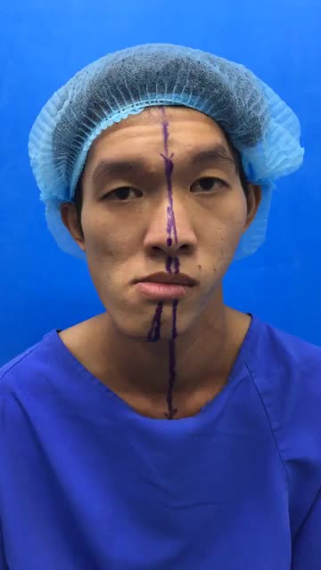 Quy trình thăm khám trước phẫu thuật chỉnh hình hàm mặt lệch khó tại Kangnam