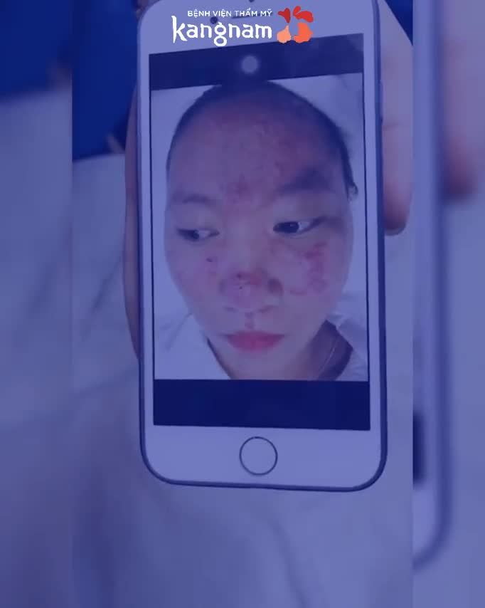 Mụn VIÊM bùng phát, kéo dài 2 năm