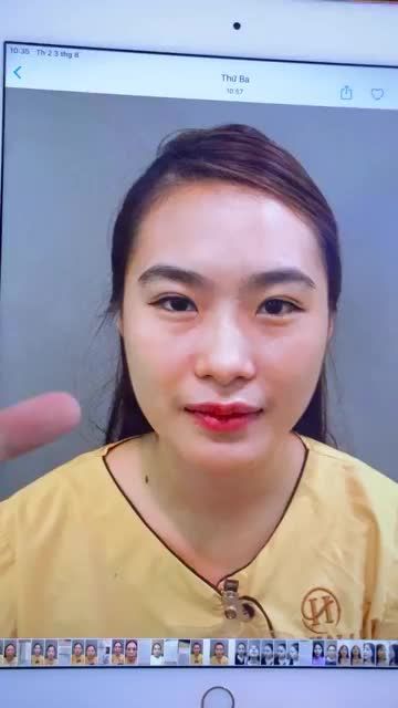 Đã từng Nhấn mí không ưng ý em gái quyết định đến Dr.Hải Lê sửa lại  đôi mắt 2 mí to rõ ràng sắc nét hơn với kỹ thuật Sửa mí Deeptech20