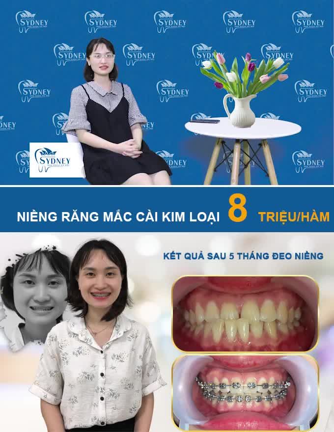 MẮC CÀI KIM LOẠI - CỨU TINH CỦA HÀM RĂNG MÓM