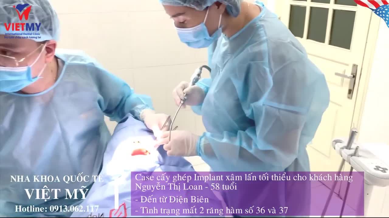 Case Trồng răng Implant xâm lấn tối thiểu- Lấy lại hàm răng trọn vẹn