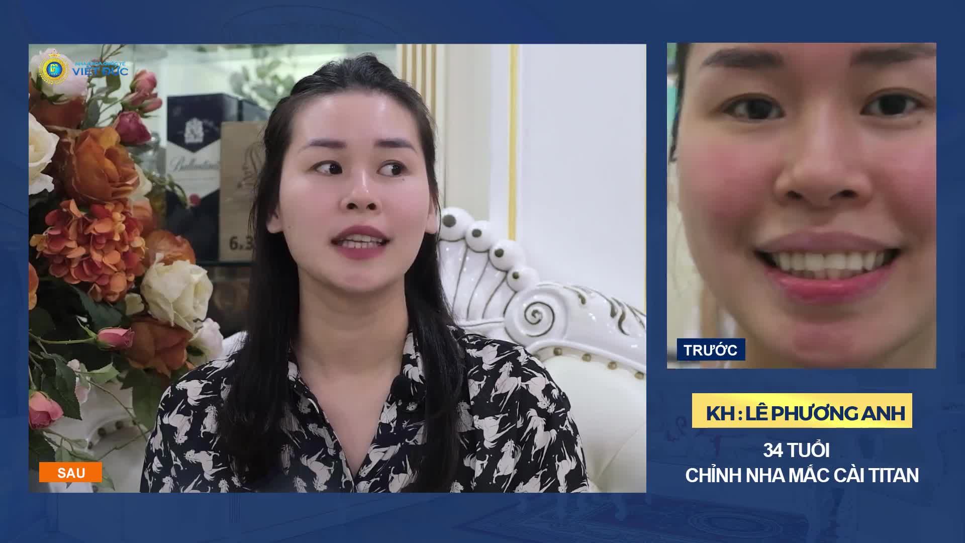 HƠN 30 TUỔI MỚI NIỀNG RĂNG – TƯỞNG KHÔNG HIỆU QUẢ MÀ HIỆU QUẢ KHÔNG TƯỞNG