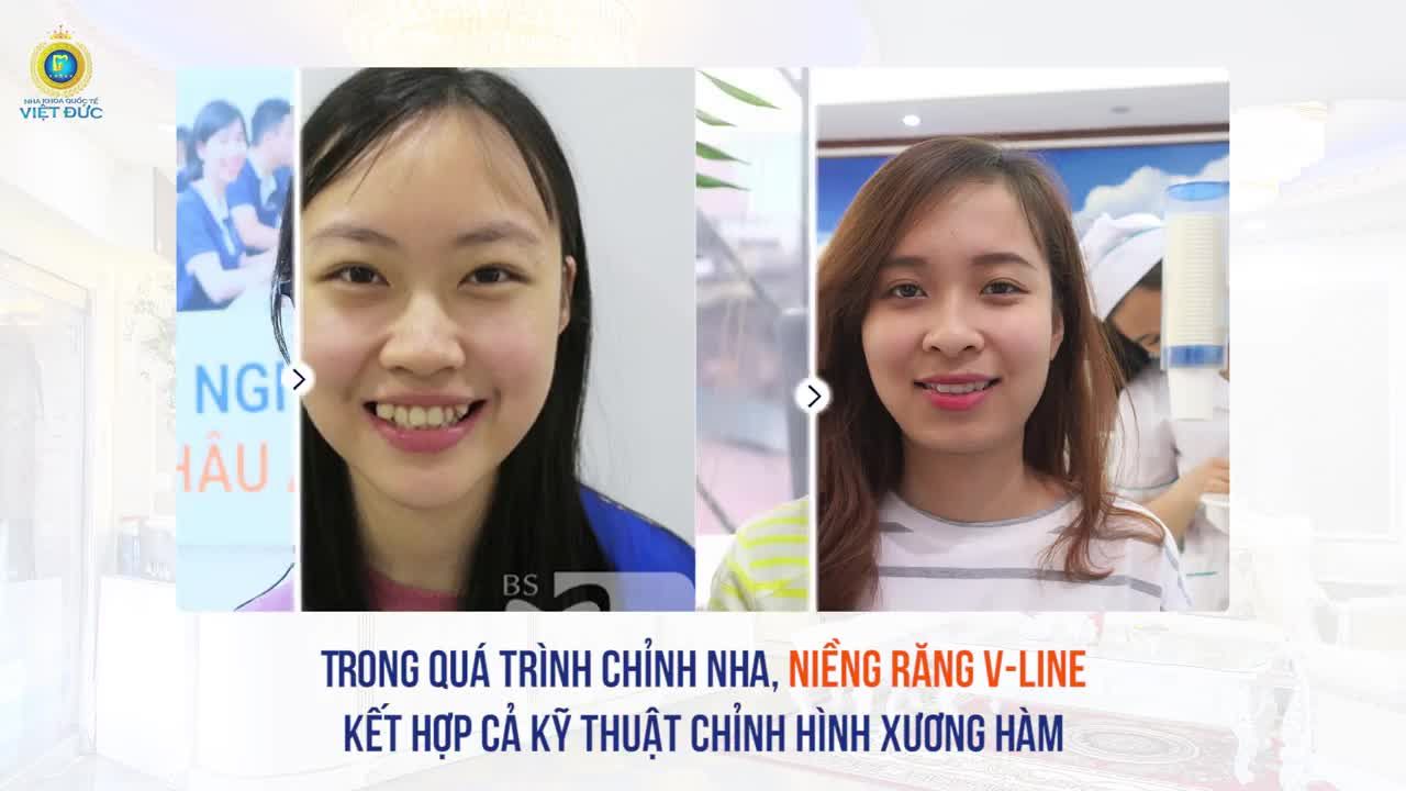 KHÔNG CẦN DAO KÉO NIỀNG RĂNG VLINE SỞ HỮU NGAY RĂNG ĐẸP – CẰM GỌN – MẶT XINH