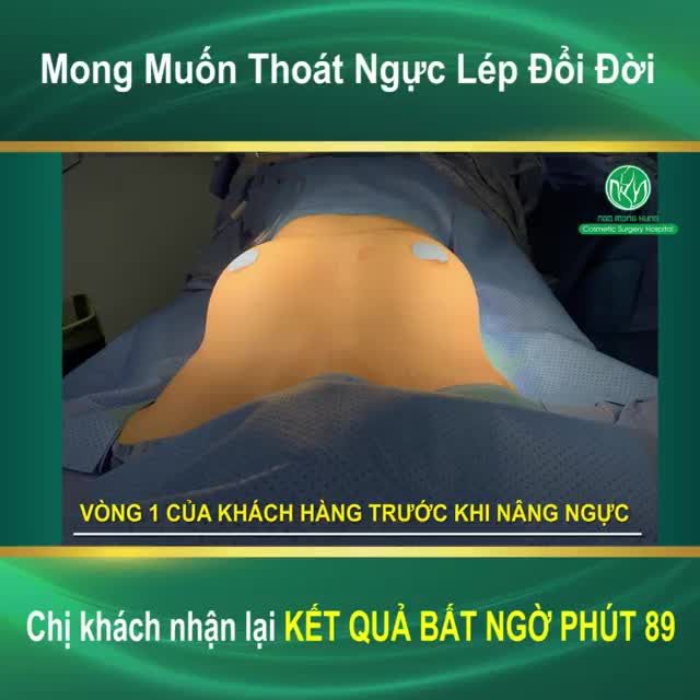 Mong Muốn Thoát Ngực Lép Đổi Đời Chị khách đã đến Bệnh viện Thẩm mỹ Ngô Mộng Hùng TÂN TRANG VÒNG 1 TRÀN BỜ