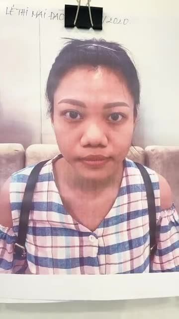 MŨI CẤU TRÚC SURGIFORM CHO NỀN MŨI TO