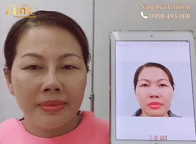 Nếu bạn muốn có được 1 chiếc mũi sửa Tự Nhiên - Hài Hoà với khuôn mặt Hãy lựa chọn Dáng Mũi Uniform.