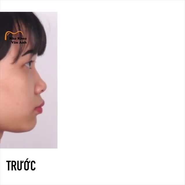 NIỀNG RĂNG VỚI CÔNG NGHỆ BIẾT TRƯỚC KẾT QUẢ  LẦN ĐẦU TIỀN XUẤT HIỆN TẠI MIỀN BẮC