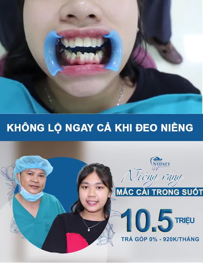 NIỀNG RĂNG VỚI MẮC CÀI TRONG SUỐT
