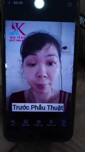 TÁI KHÁM CA CẮT MẮT LIỆT BẨM SINH SAU 1 THÁNG