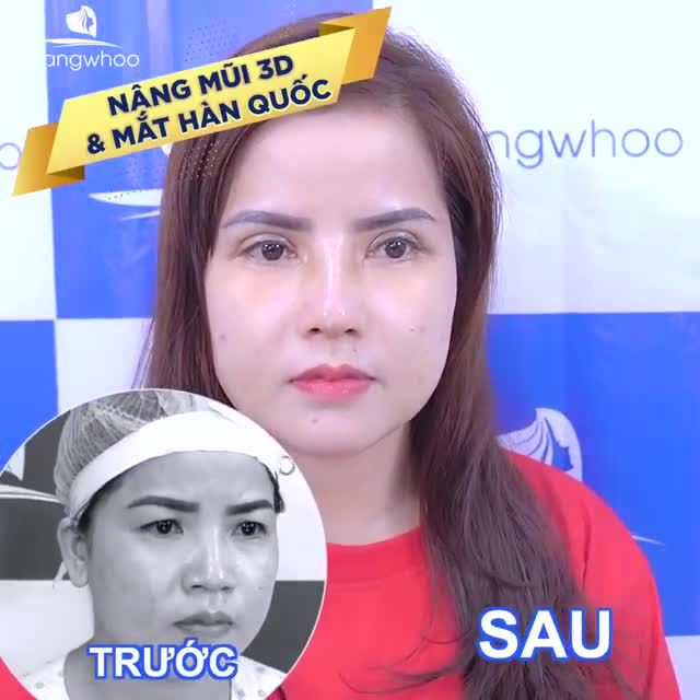 TÁI KHÁM COMBO NÂNG MŨI CẤU TRÚC 3D, MẮT HÀN QUỐC - GƯƠNG MẶT THẦN THÁI, TỰ TIN THẤY RÕ