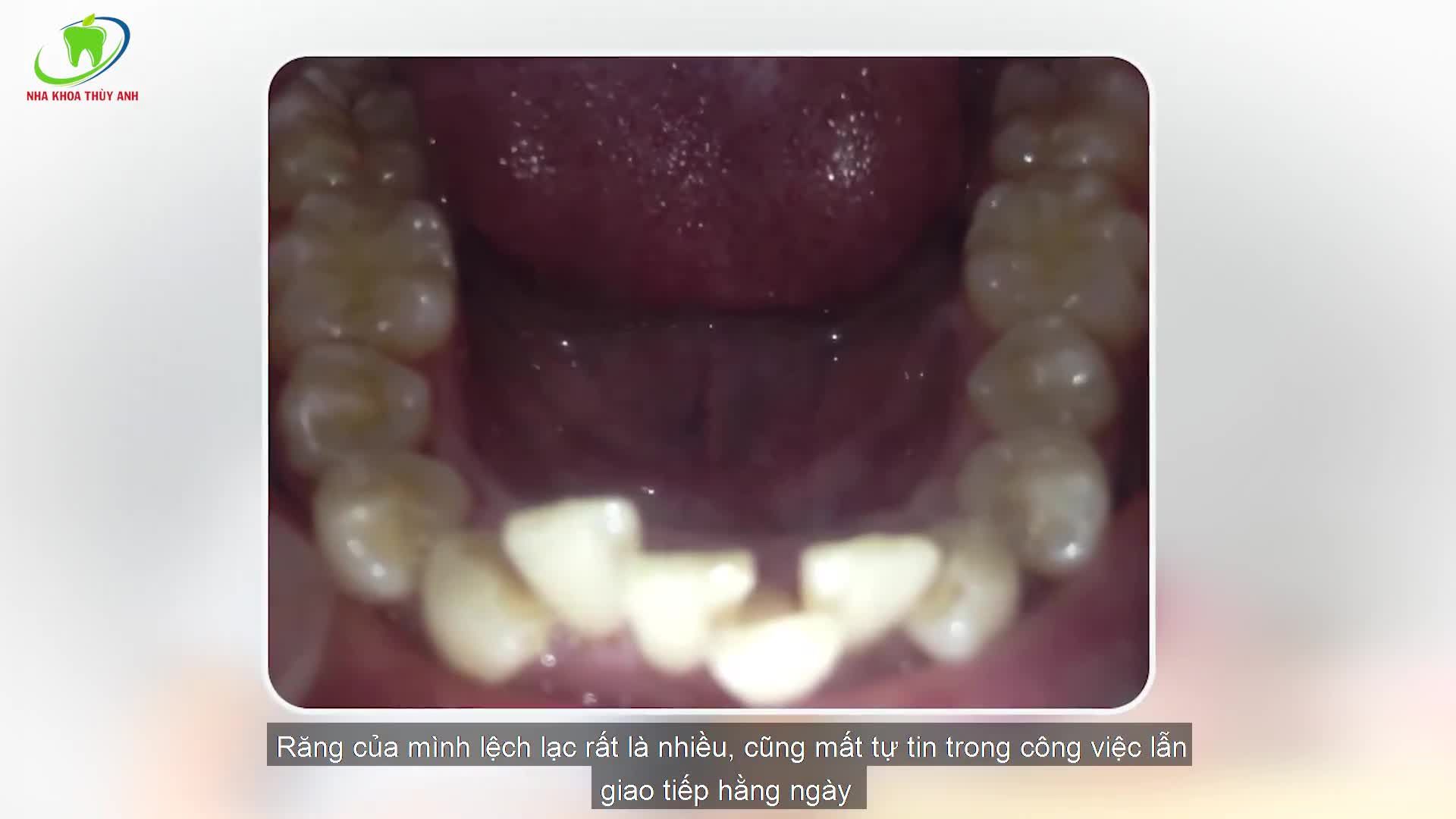 Tìm lại nụ cười sau 28 năm nhờ niềng răng tại Nha Khoa Thùy Anh