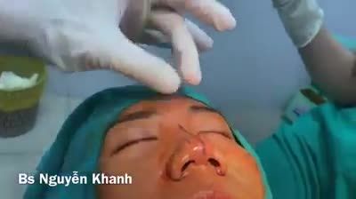 Trời đã sinh ra phương pháp thu chóp cớ sao còn bắt mũi chóp to phải làm cấu trúc?