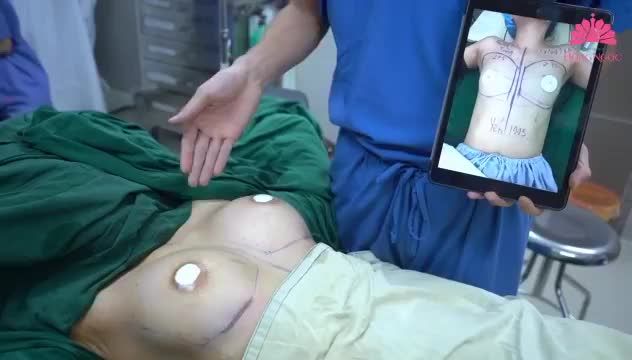 CA PHẪU THUẬT NÂNG NGỰC THỨ 2 TRONG NGÀY!