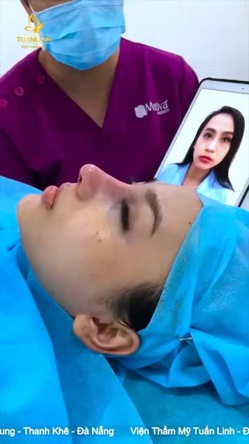 Case Nâng mũi siêu cấu trúc Surgiform