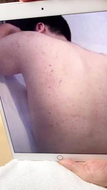 "Ngỡ ngàng" với kết quả điều trị mụn lưng tại Kangnam sau 5 buổi điều trị với công nghệ De Acne