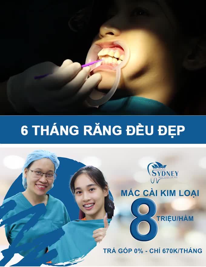 TẠI SAO MẮC CÀI KIM LOẠI CÓ CHI PHÍ THẤP NHẤT