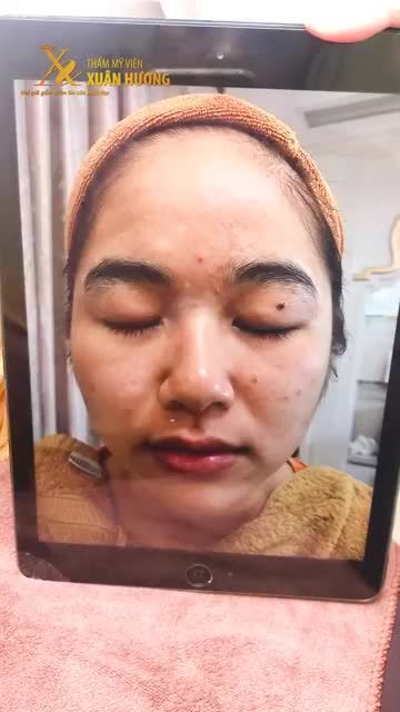 VÙNG CHỮ T ĐỔ DẦU BÓNG NHẪY, DA MẶT TỔN THƯƠNG DO MỤN