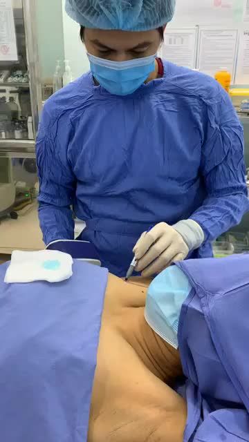 Khử mùi hôi nách vĩnh viễn với công nghệ Hút tuyến nội soi.