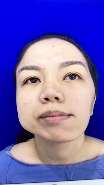 Cô gái mặt lệch thay đổi 180 độ sau khi phẫu thuật CHỈNH HÌNH HÀM MẶT tại kangnam - Tái khám 1 tháng với kết quả thay đổi bất ngờ
