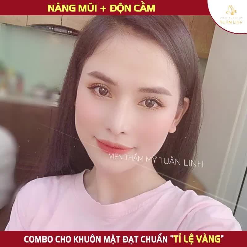NÂNG MŨI  ĐỘN CẰM COMBO KHUÔN MẶT XINH SANG VÔ ĐỐI