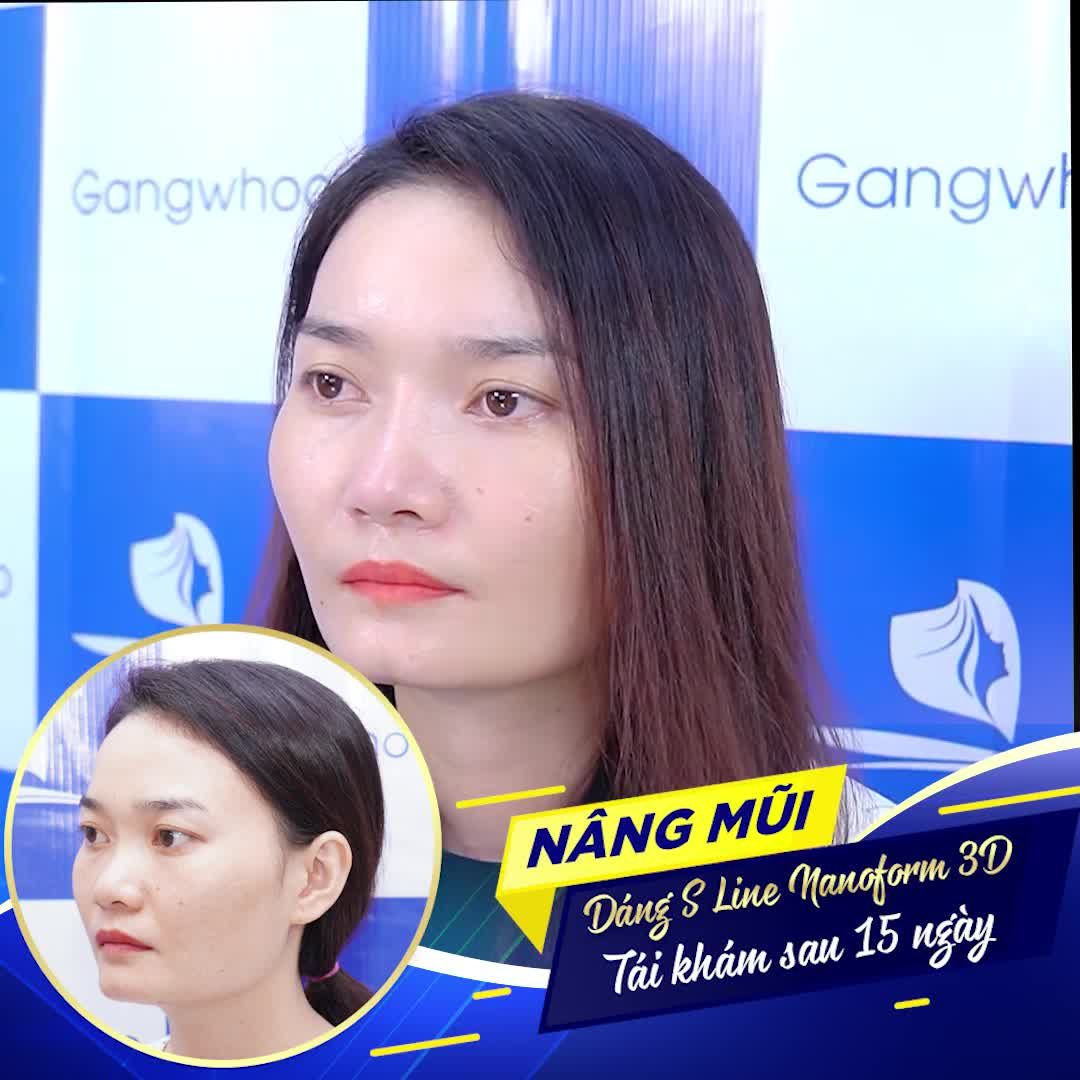 TÁI KHÁM DÁNG MŨI SLINE 3D SAU 2 TUẦN - DIỆN MẠO MỚI ĐẸP TỰ NHIÊN HOÀN HẢO TỪNG CHI TIẾT