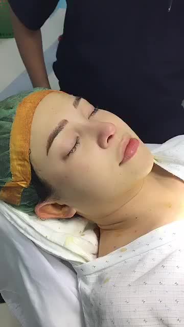 CA MŨI SỬA LẠI VỪA XONG