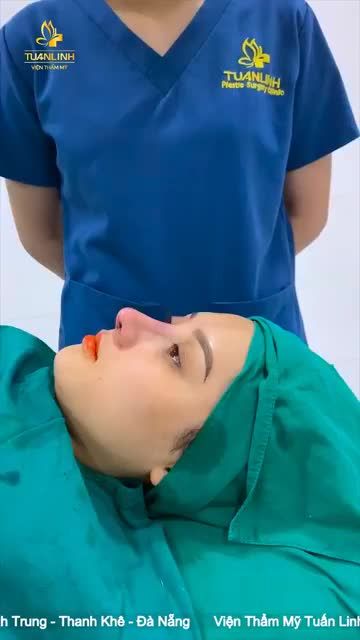 Nâng mũi cấu trúc Sụn Surgiform - Mũi sửa lại