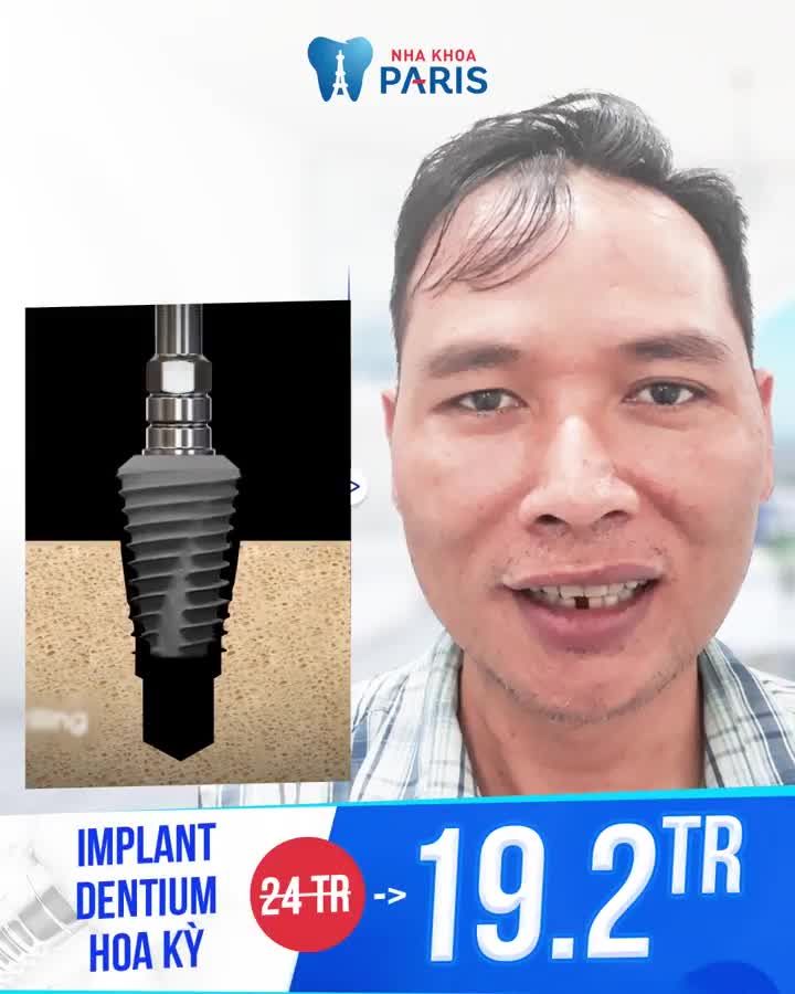 Trồng răng Implant - Bảo hành trọn đời mọi loại trụ