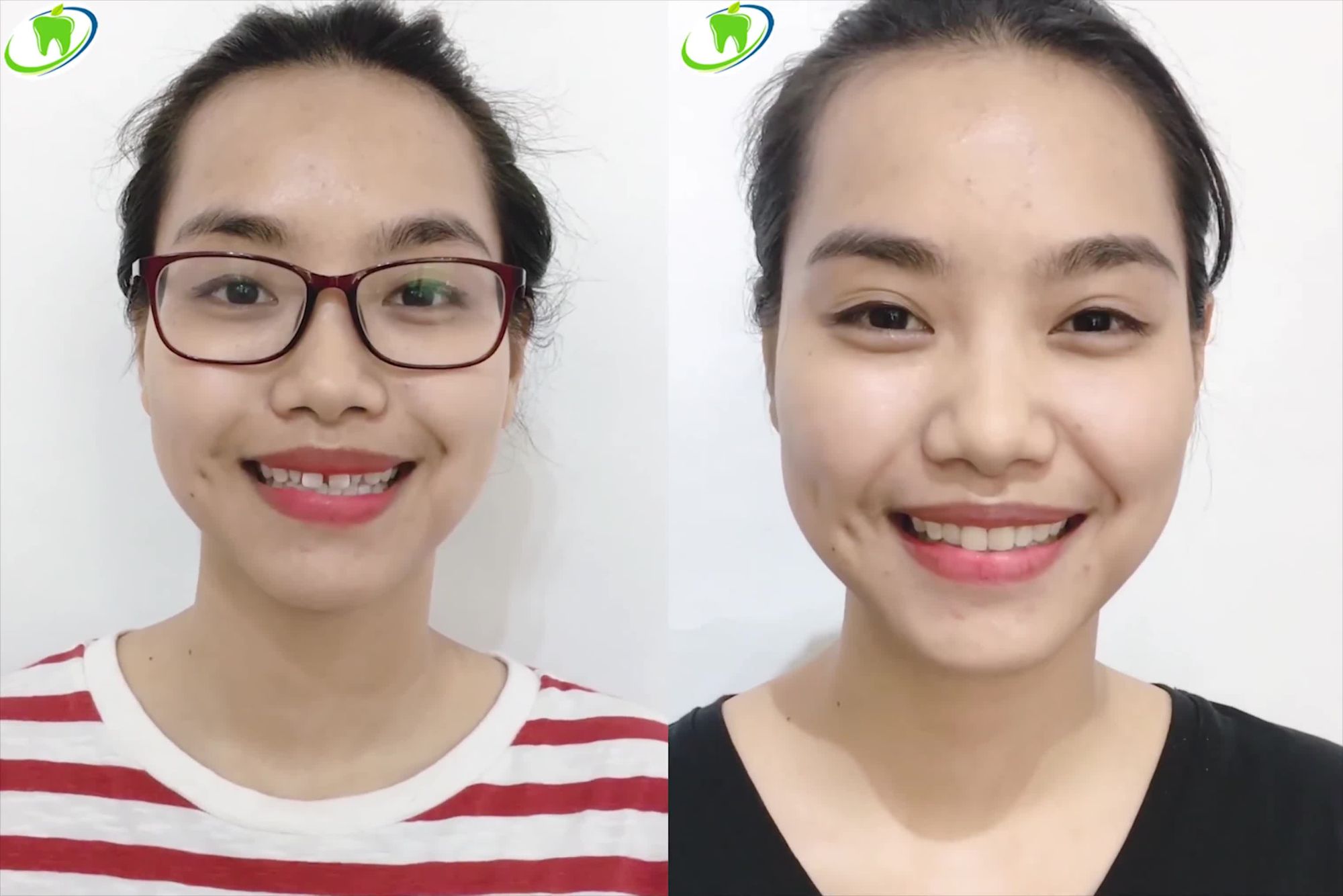 XÓA BỎ RĂNG THƯA , DỊ DẠNG NHỜ PHƯƠNG PHÁP DÁN SỨ  VENEER