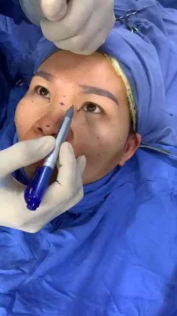 Phẫu thuật COMBO 2 dịch vụ "MỞ KHOÉ TRONG - NÂNG MŨI CẤU TRÚC 4D"