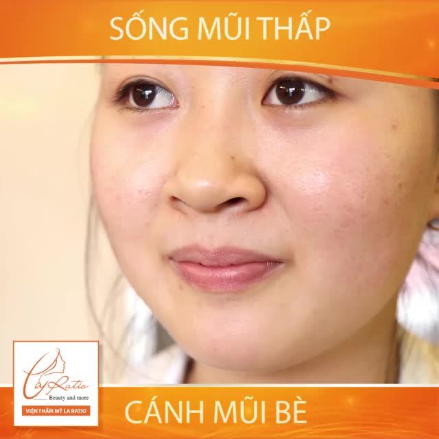 ️BẠN SẼ THAY ĐỔI NHƯ THẾ NÀO SAU KHI NÂNG MŨI MEGA S️