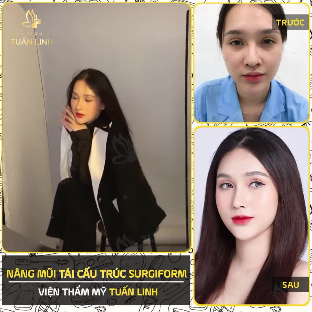NÂNG MŨI SỬA ĐI SỬA LẠI - NỖI ÁM ẢNH KHÔNG CỦA RIÊNG AI !!