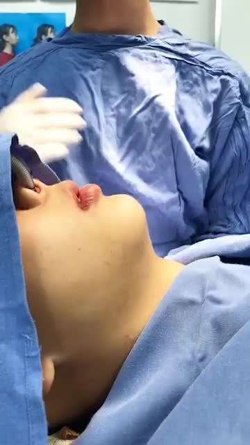 Kết quả ngay sau khi phẫu thuật Chỉnh hàm hô 2 hàm kết hợp trượt cằm tại Bệnh viện thẩm mỹ Kangnam.
