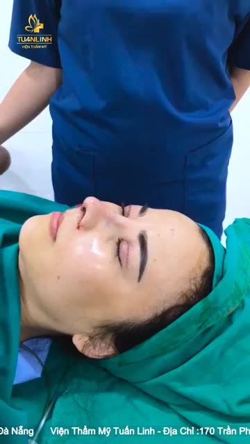 Case Nâng mũi siêu cấu trúc sụn Surgiform kết hợp Cuộn cánh mũi + Cắt mí