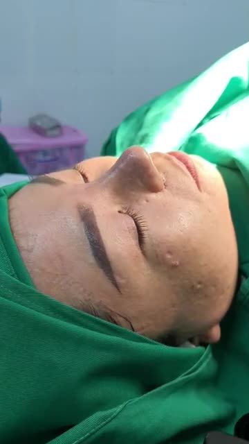 GIẢI CỨU MŨI HỎNG