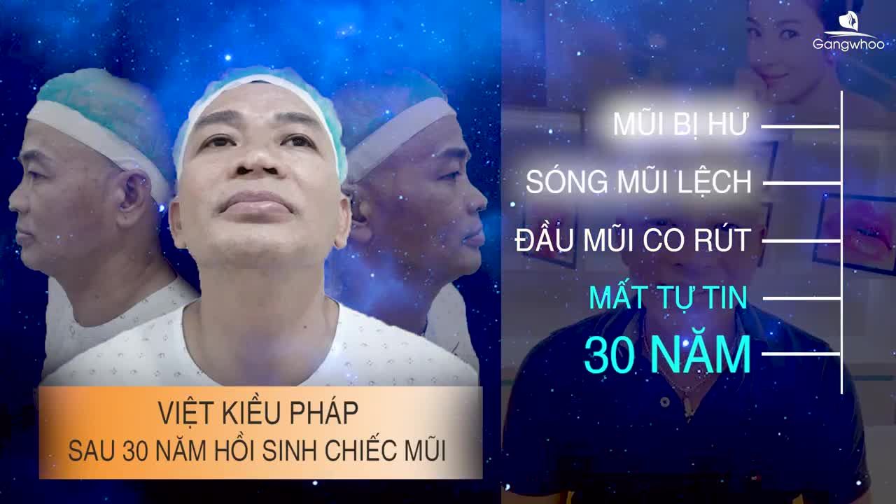HỒI SINH CHIẾC MŨI TAI NẠN BIẾN DẠNG NẶNG 30 NĂM CHO CHÀNG TRAI VIỆT KIỀU PHÁP