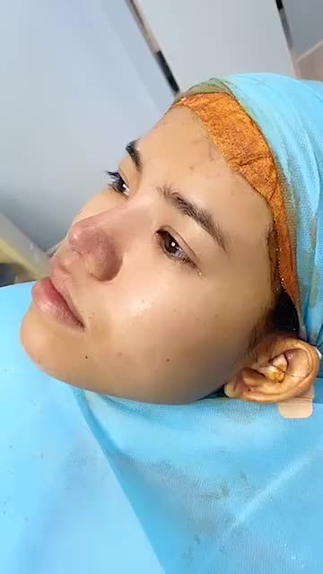 HOT HOT HOT LIVE STREAMS KHÁCH HÀNG NÂNG MŨI CẤU TRÚC SỬA LẠI