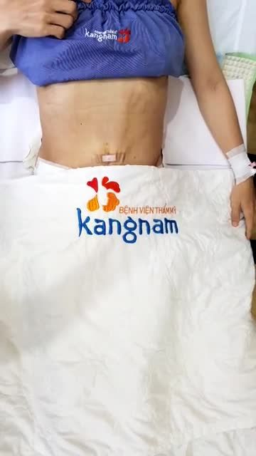 Sau GIẢM M.Ỡ + Tạo hình eo Khách hàng VỀ DÁNG ngoạn mục