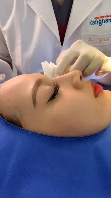 Khách hàng "lột xác" 360 độ sau khi nâng mũi công nghệ Nâng mũi bán trúc 4D