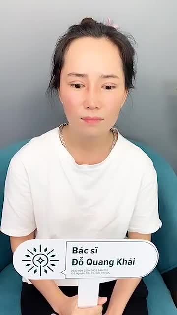 Ca nâng mũi cấu trúc và cắt mí sau 10 ngày