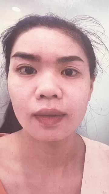 Khách hàng nâng mũi cấu trúc sụn tai khắc phục khuyết điểm sóng mũi thấp, đầu mũi ngắn