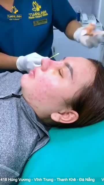 Case: Cắt mí Nâng mũi cấu trúc sụn Surgiform tái khám sau 10 ngày