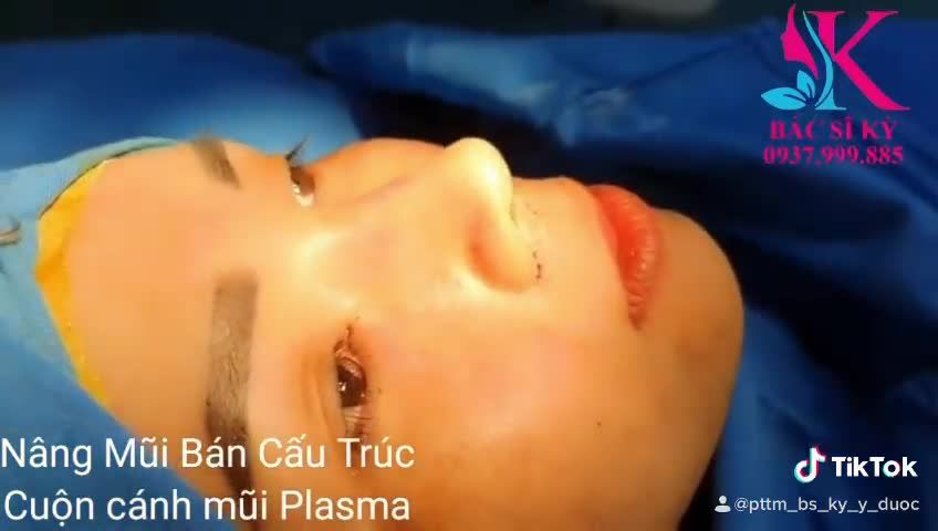 NÂNG MŨI BÁN CẤU TRÚC SỤN TI ĐA LỚP + CUỘN CÁNH MŨI PLASMA