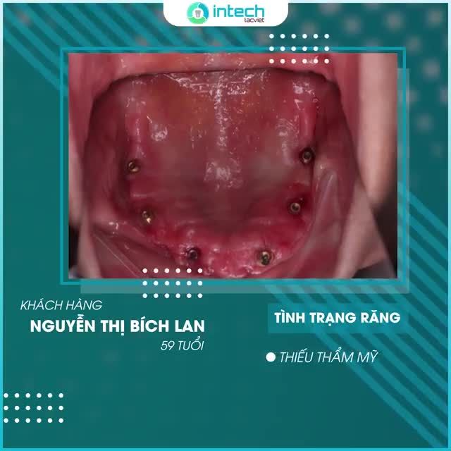 TÌM LẠI NỤ CƯỜI TUỔI TRẺ NHỜ TRỒNG RĂNG TẠI LẠC VIỆT INTECH