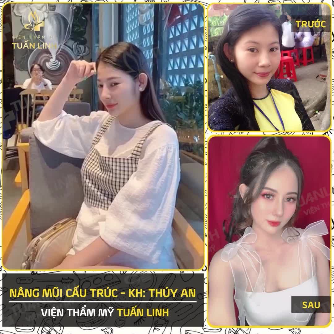 Chị khách Thúy An - chọn dịch vụ nâng mũi cấu trúc tại VTM Tuấn Linh.