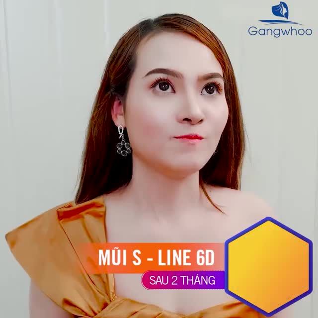 CÔ GÁI CÓ SỐNG MŨI THẤP, CÁNH MŨI TO BÈ LỘT XÁC DIỆN MẠO VỚI NÂNG MŨI CẤU TRÚC 6D DÁNG SLINE