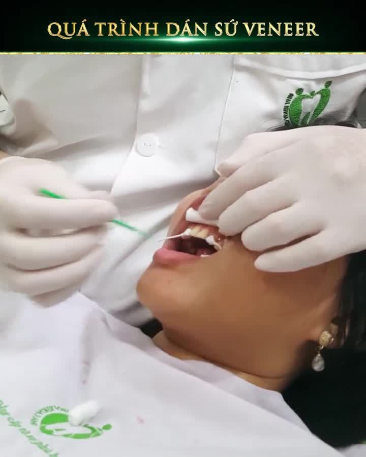 DÁN SỨ VENEER: ĂN NHAI THOẢI MÁI – KHÔNG LO BONG RỤNG
