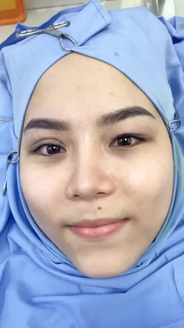 MÍ ĐẸP NGAY SAU NHẤN MÍ EYELID PLUS TẠI TMV XUÂN HƯƠNG Khác biệt rõ rệt giữa mí đã và chưa nhất Theo dõi ngay!